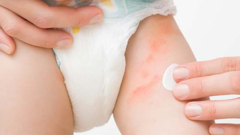 Pp Rash Understanding and Preventing Nappy Rashes in Children - Dr Parents