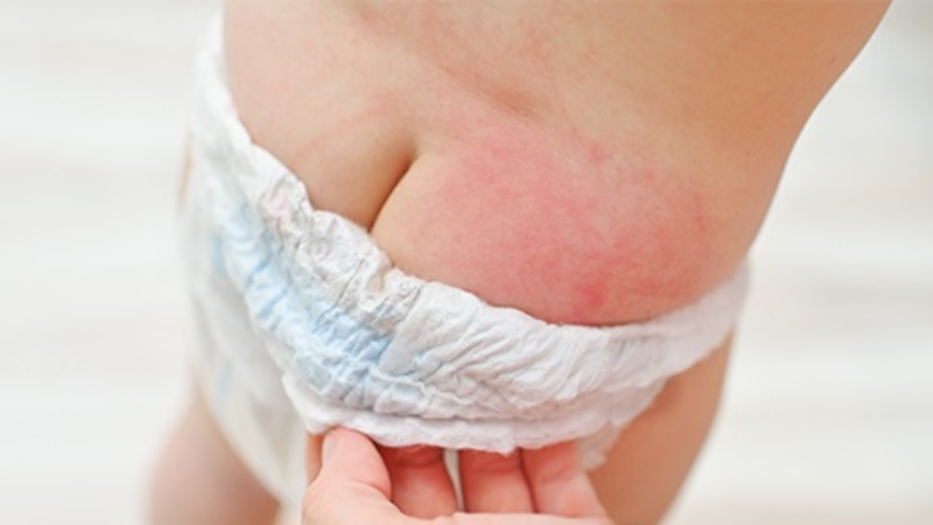 Understanding and Preventing Nappy Rashes in Children - Dr Parents