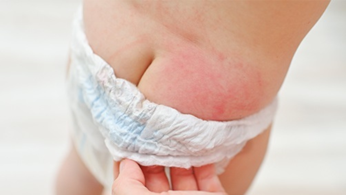 Normal Nappy Rash Understanding and Preventing Nappy Rashes in Children - Dr Parents