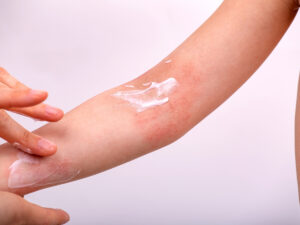 eczema
