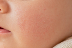 close-up of dry eczema patch on baby's cheek